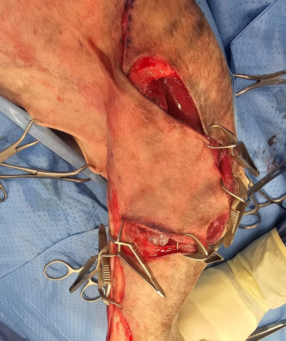 <b>Técnica quirúrgica</b>. Se identifica y sujeta el pliegue inguinal para delimitar sus bordes medial y lateral, que se marcarán con un rotulador estéril, y se determinará si la zona donante puede cerrarse sin tensión excesiva. Para defectos de la región media del muslo y tibia proximal: las incisiones medial y lateral se conectarán por la parte proximal del pliegue inguinal. Para defectos en muslo proximal, cadera o abdomen: las incisiones medial y lateral se conectarán por la parte distal del pliegue (justo por encima de la rodilla). El colgajo se eleva cuidadosamente preservando el plexo subdérmico y se transpone al defecto de forma directa o mediante una incisión puente si no es adyacente.