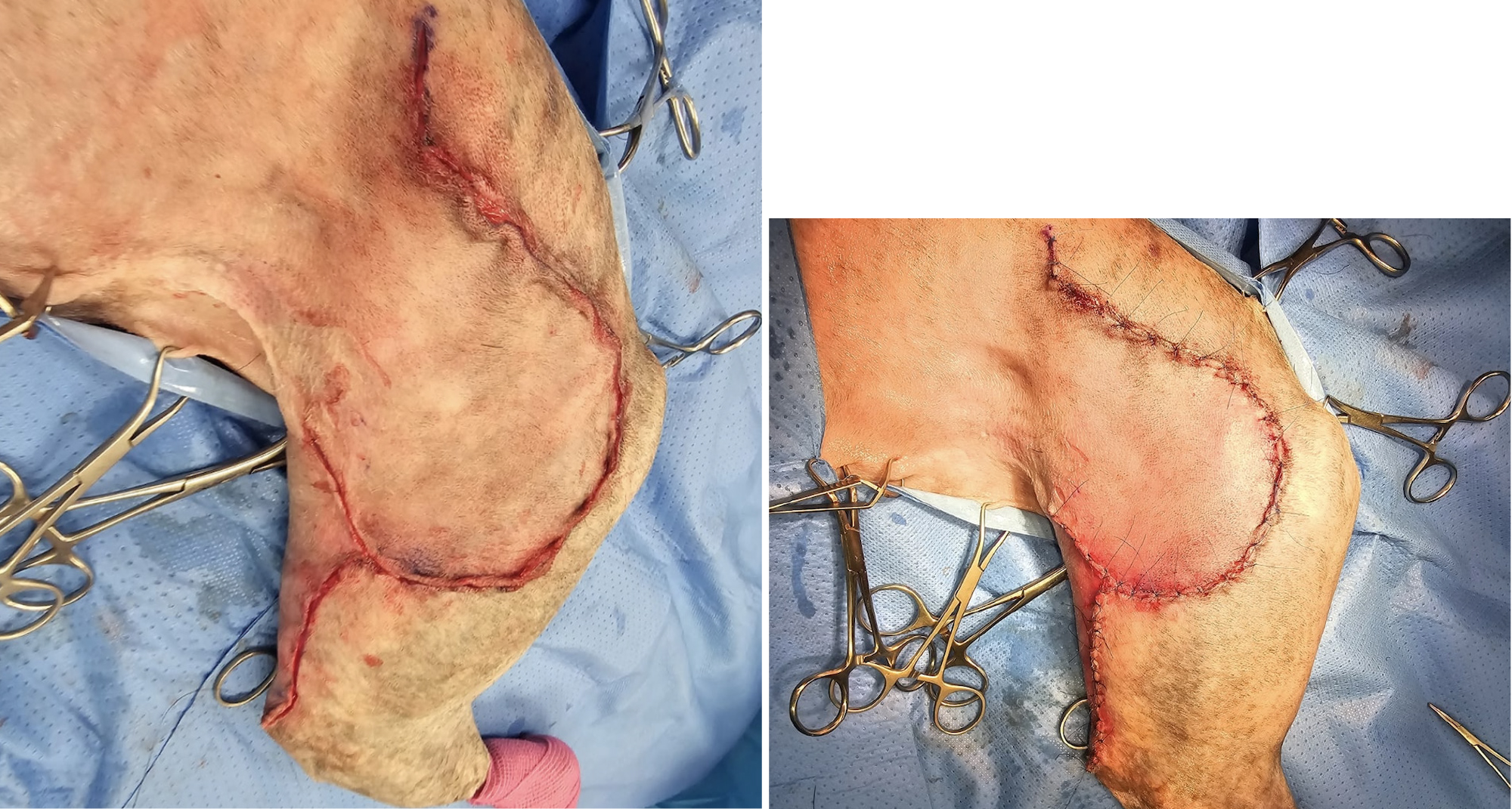 <b>Cierre</b>. El colgajo del pliegue inguinal transpuesto y la zona donante se cierran en dos planos: (<b>1</b>) Subcutis: patrón simple continuo con monofilamento absorbible. (<b>2</b>) Piel: patrón simple continuo o discontinuo con monofilamento no absorbible.