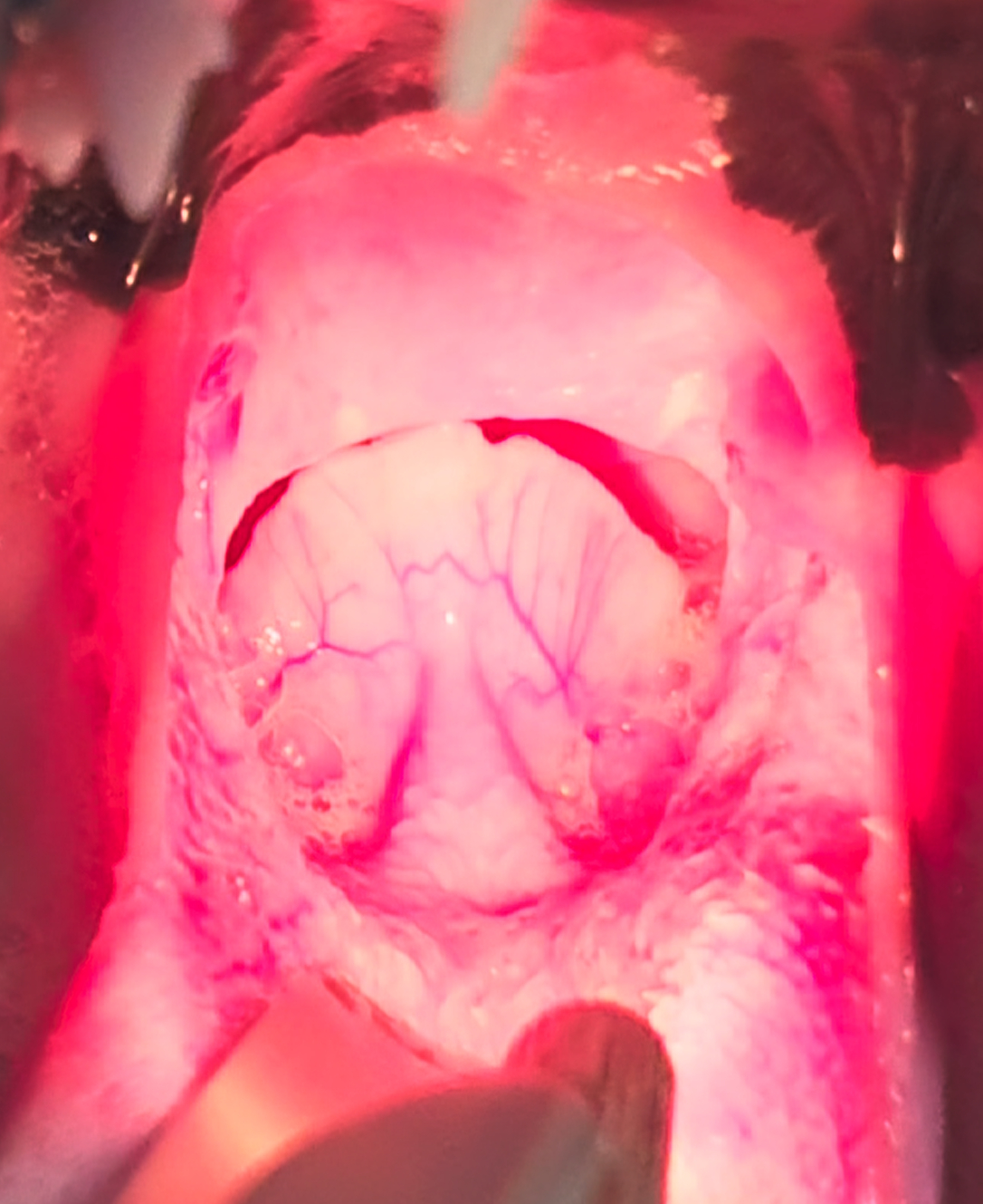 Detalle de retroversión epiglótica de alto grado (retroflexión de la epiglotis en fase de inspiración con obstrucción completa de la <i>rima glottidis</i>).